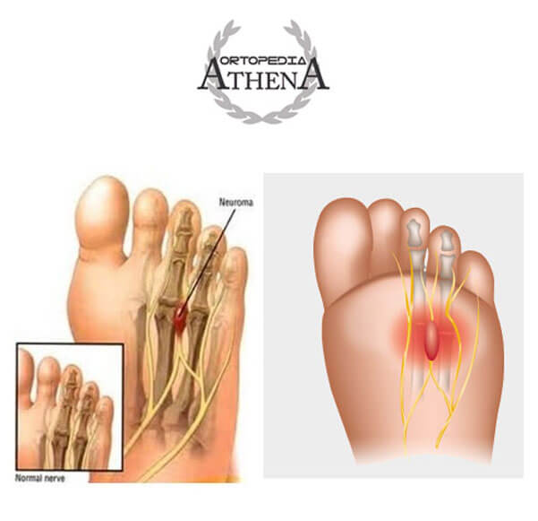 neuroma di Morton