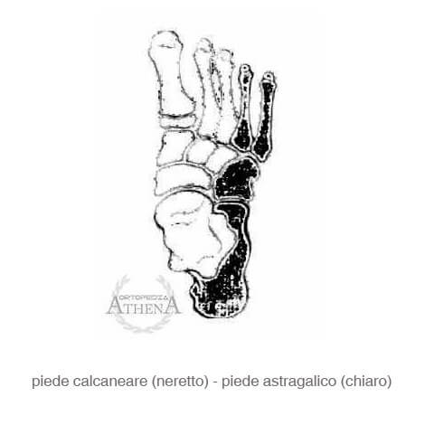 piede calcaneare e piede astragalico